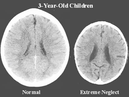 Bild: truththeory.com/2013/11/19/brain-scans-show-the-real-impact-love-has-on-a-childs-brain/ 